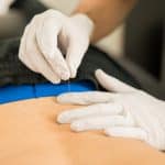 Osteopathy - Trigger point therapy or dry needling by Ludgate Clinic